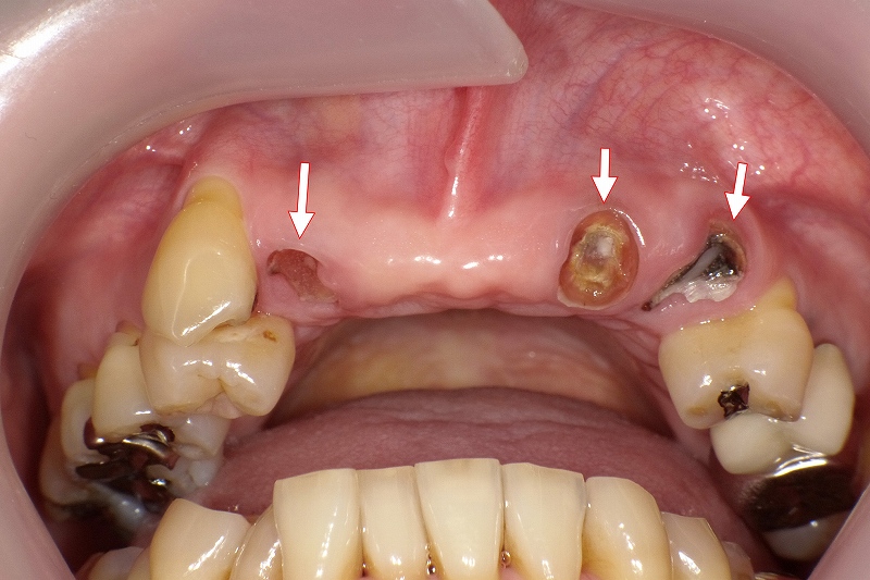 術前ー虫歯C4の残根が３本