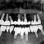 インプラント多数歯欠損症例