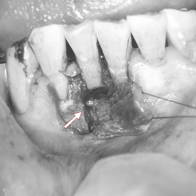 歯根端切除術と歯根嚢胞摘出術