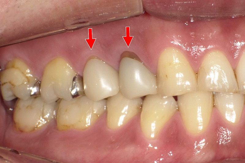 右側の小臼歯2本の側面観