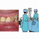 全身麻酔の手術前後で歯周病放置は合併症リスクが上昇