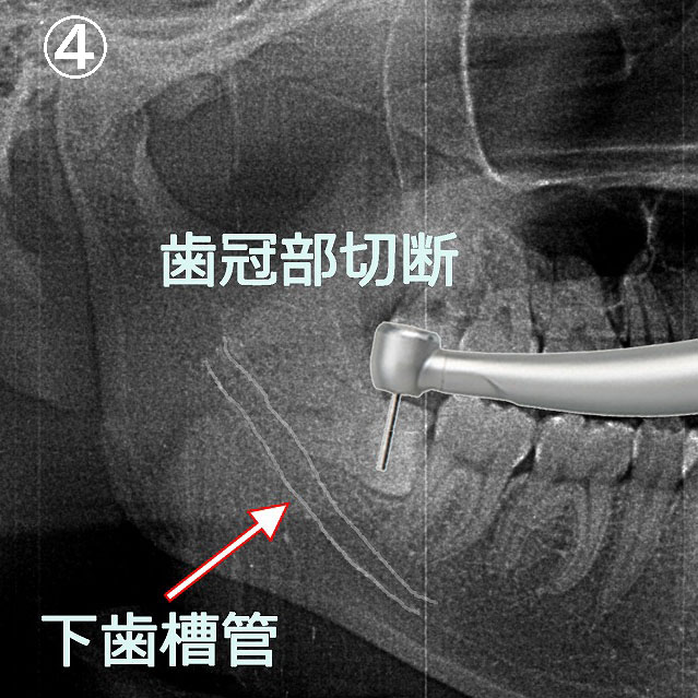 歯冠部切断