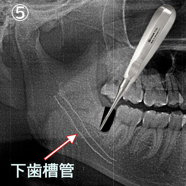 歯根の抜歯
