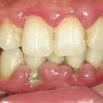 歯石取りと歯のクリーニングだけで歯茎の腫れが改善
