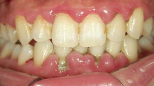 歯石取りと歯のクリーニングだけで歯茎の腫れが改善