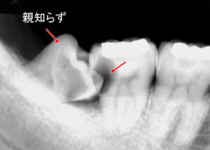 虫歯の痛み｜原因は斜めに生えた親知らず