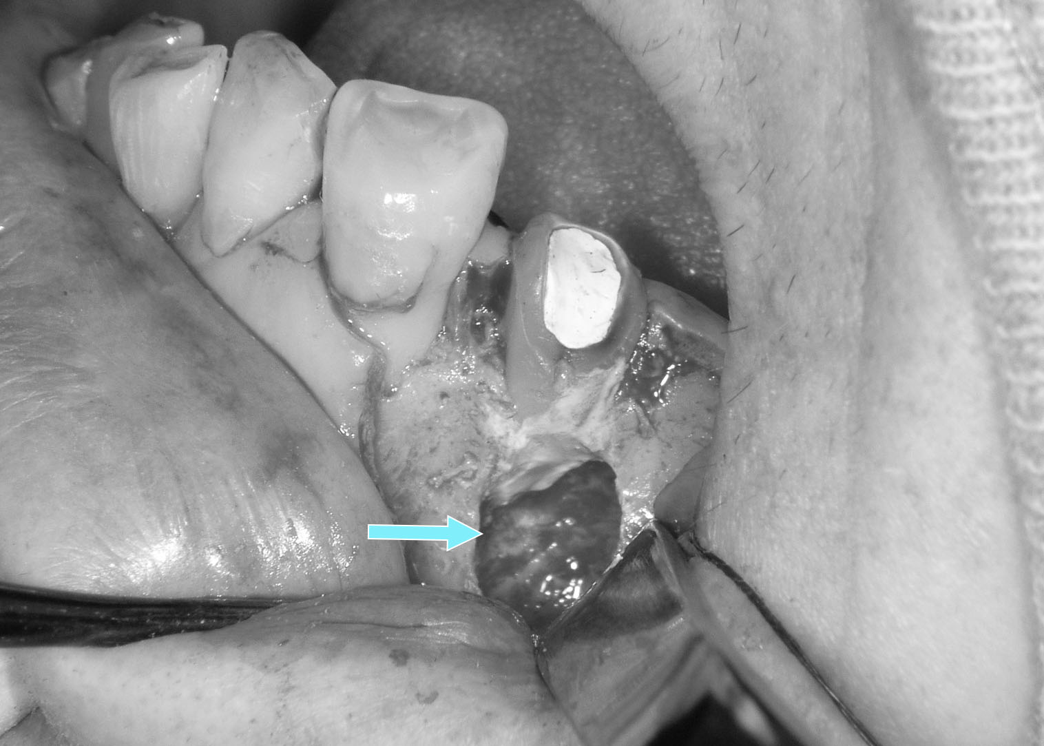 歯根端切除術・歯根嚢胞摘出術にも対応