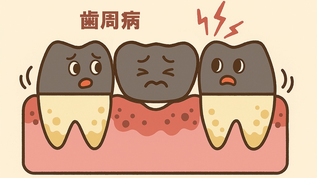歯周病によるグラつきと炎症