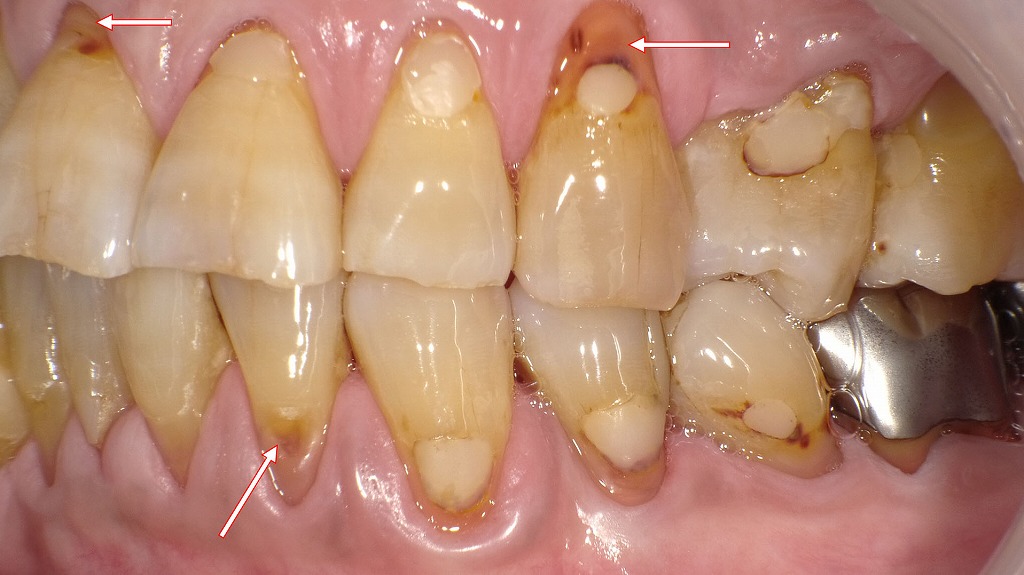 根面う蝕とは
