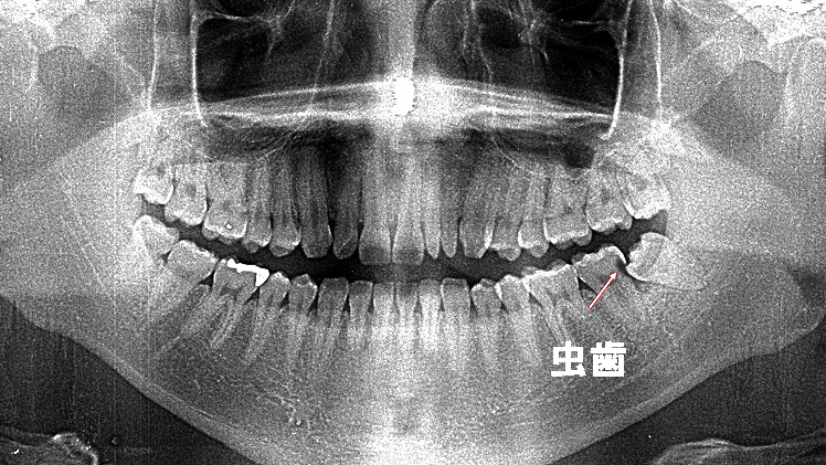 下顎7番の虫歯が見つかる