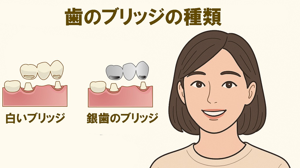 歯のブリッジの種類