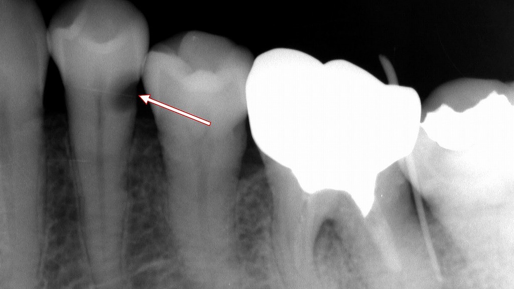 根面う蝕のX線画像診断