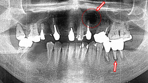 根尖病巣(歯根嚢胞)の有無を確認:2番に大きな歯根嚢胞を認める