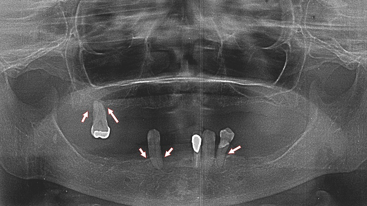 重度歯周病による歯槽骨の吸収