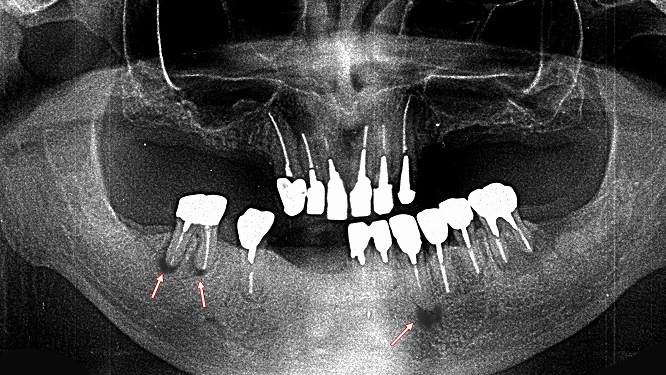 根尖病巣(歯根嚢胞)の有無を確認:下顎6番と3番に歯根嚢胞を認める