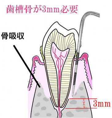 歯槽骨が3mm以上残存している