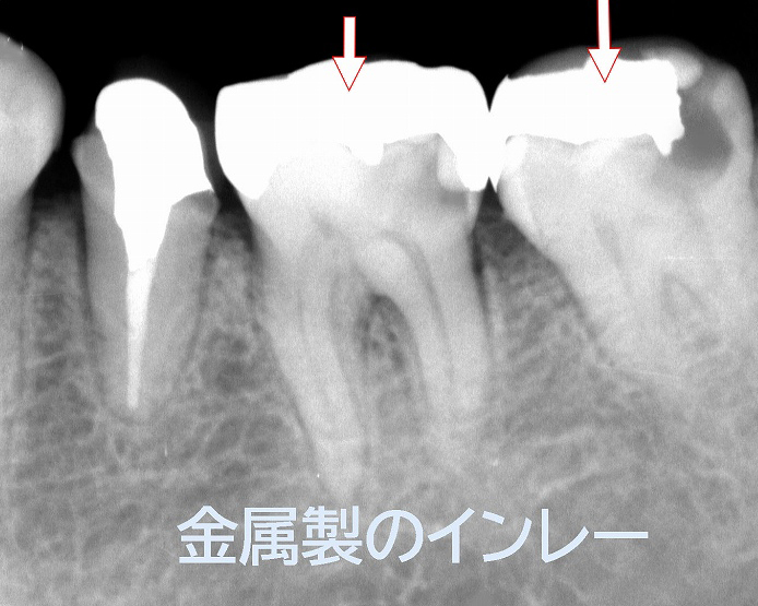 デンタルレントゲン :金属製の詰め物が白く映る