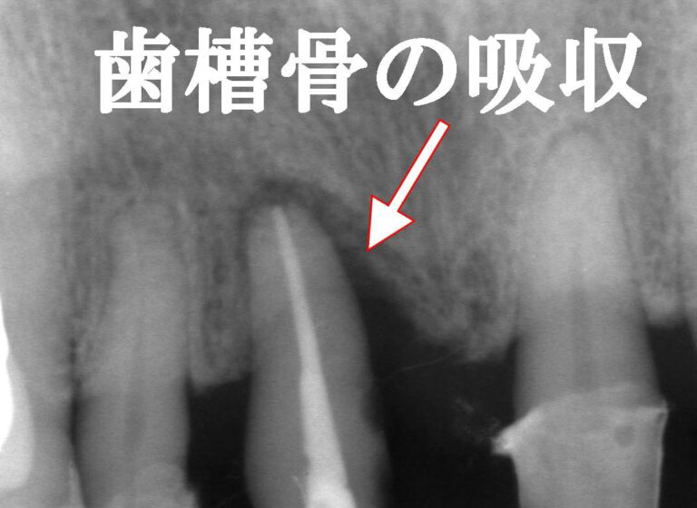 プロービングデプス10mm超えの歯槽骨吸収
