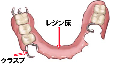 レジン床+金属バネ(クラスプ)