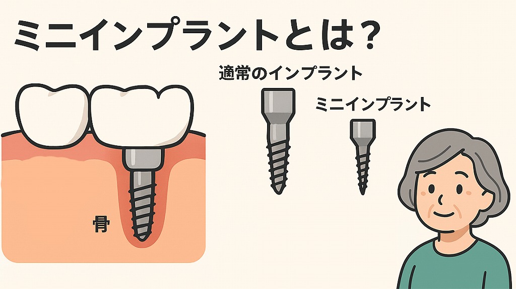 ミニインプラント