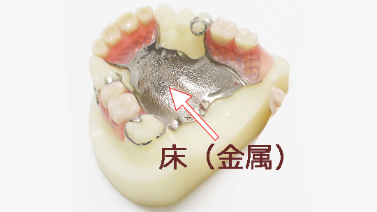 金属床義歯