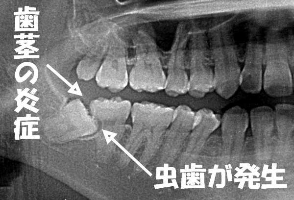 親知らずの炎症(智歯周囲炎)