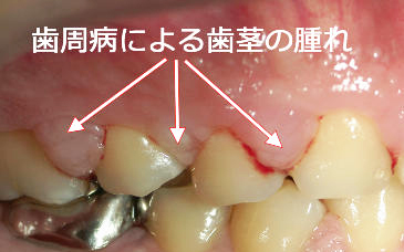 歯周病(歯肉炎・歯周炎)の腫れ
