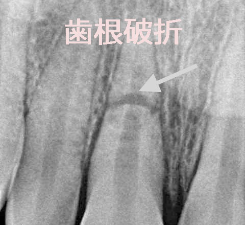 歯根破折