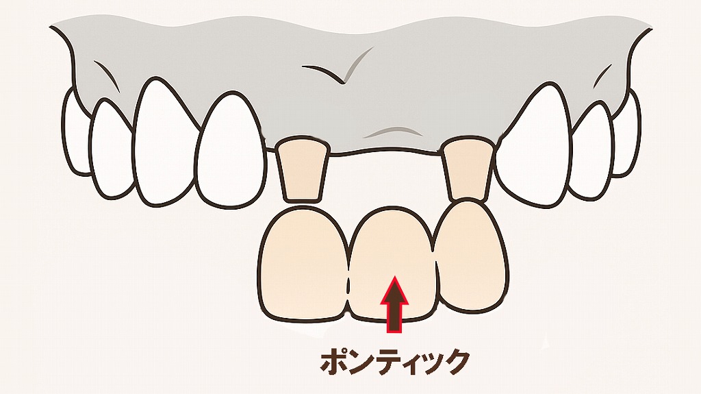 ブリッジの構造と仕組み(支台歯・ポンティック)