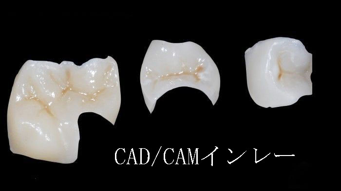 ５番・６番のCAD/CAMインレーの見た目