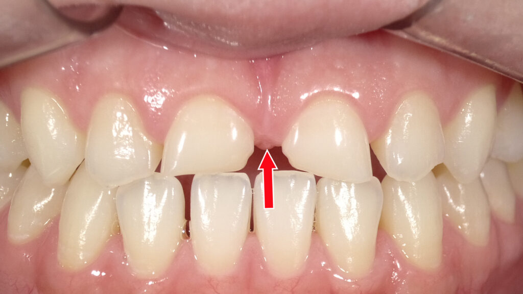 上唇小帯が長く前歯の間まで入り込んでいることが原因と考えられるすきっ歯（正中離開）