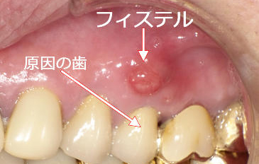 根尖性歯周炎(フィステル)