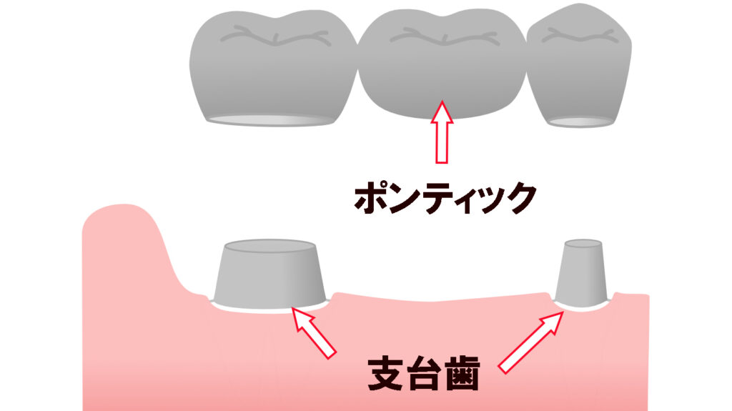 歯のブリッジの構造