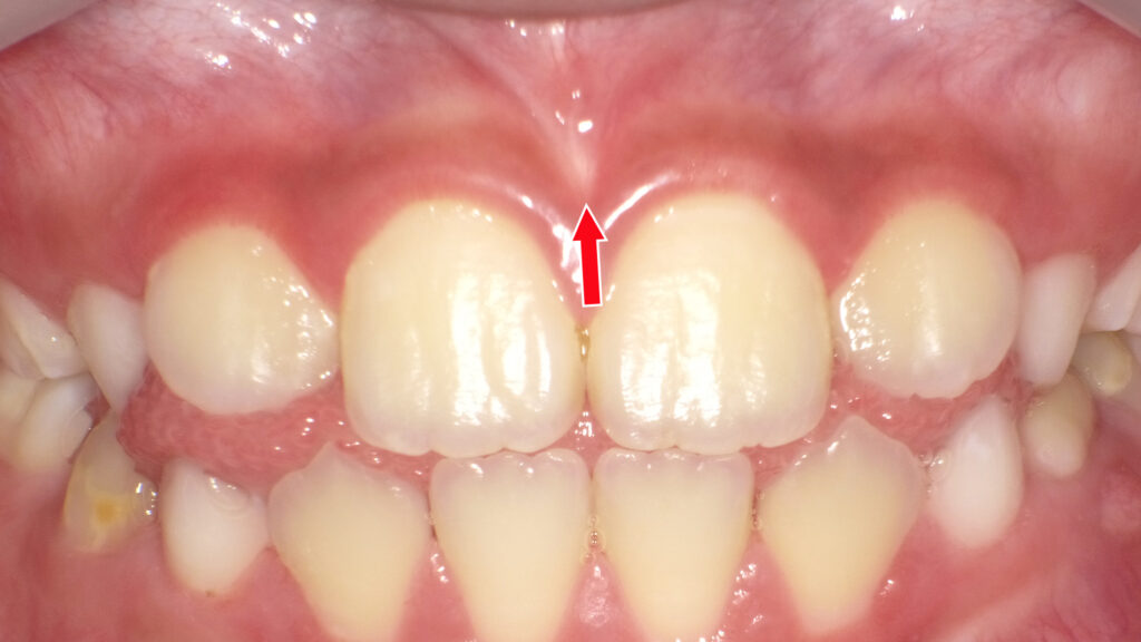 子供の上唇小帯（正常）