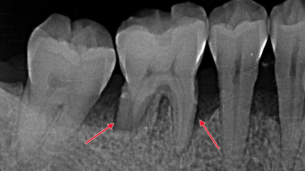重度歯周病の歯槽骨吸収のレントゲン画像