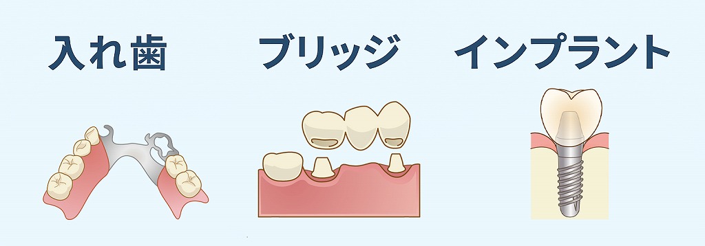 入れ歯・ブリッジ・インプラントの比較