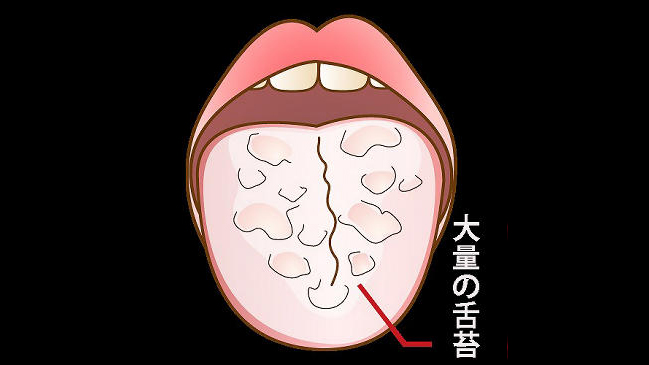 分厚い舌苔