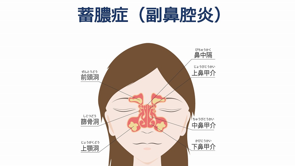 蓄膿症(副鼻腔炎)