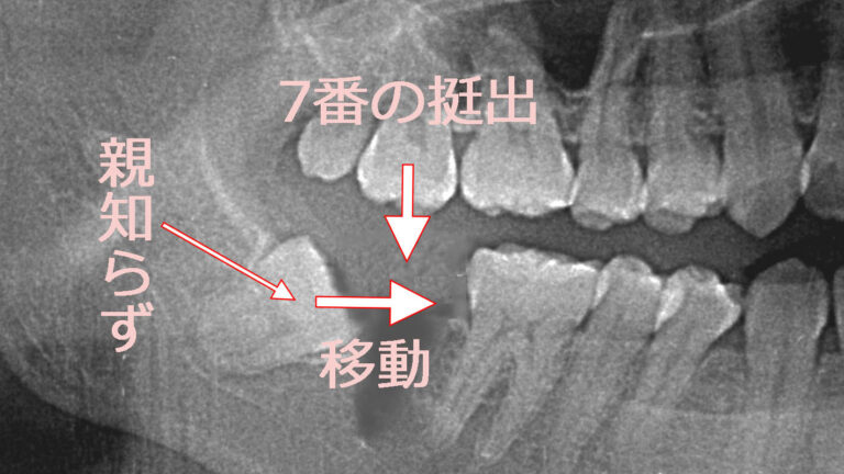 下顎親知らずの変化