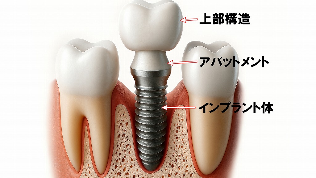 インプラントの基本構造