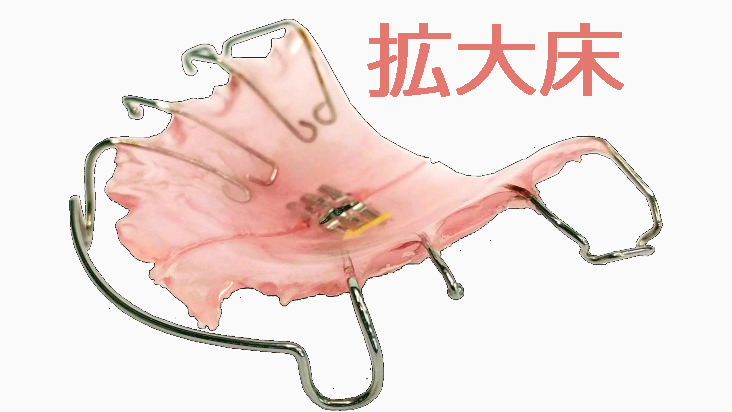 上顎拡大床