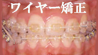マルチブラケット装置（ワイヤー矯正）
