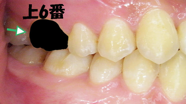 上顎6番を放置したケース