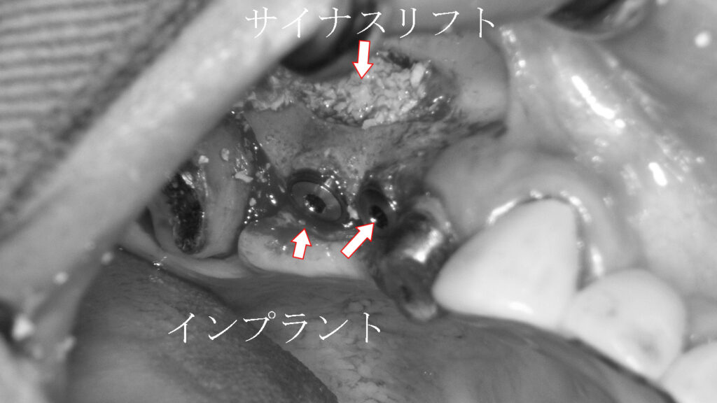 サイナスリフトを行い人工骨填入と同時にインプラントを埋入