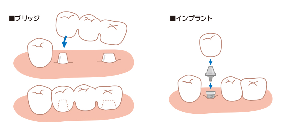 ブリッジとインプラントとは?