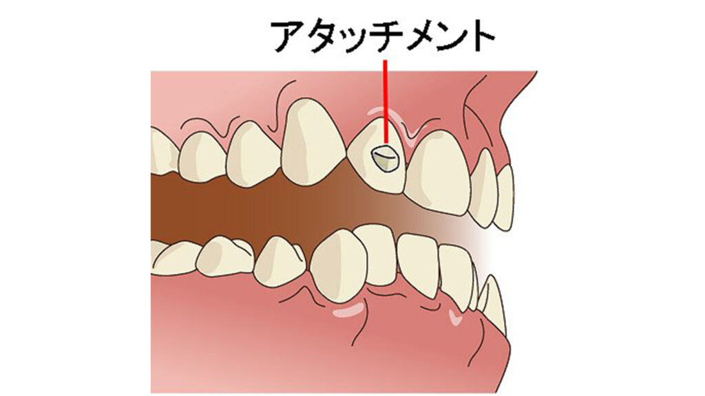 アタッチメント