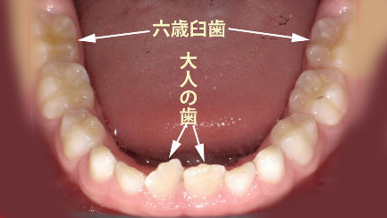 霊長空隙と発育空隙が無い子供の前歯