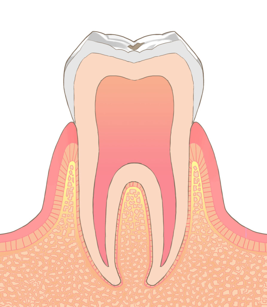 C0: 初期虫歯