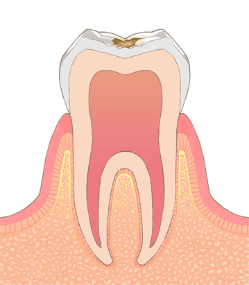 C1: エナメル質の虫歯