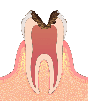 C3: 神経まで達した虫歯